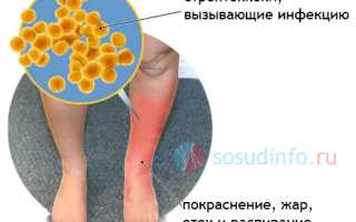 Рожистое воспаление: причины, проявления, признаки, методы лечения