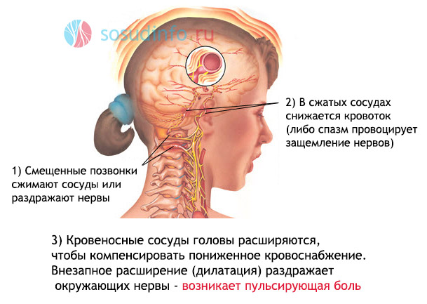 шейная мигрень
