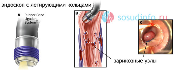 легирование варикозных вен пищевода