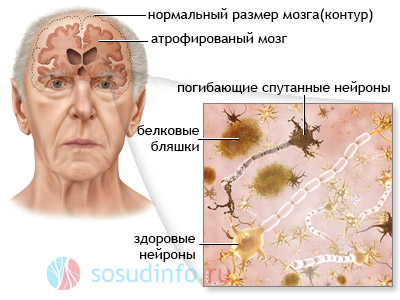 Патологический процесс в мозге больного деменцией альцгеймеровского типа