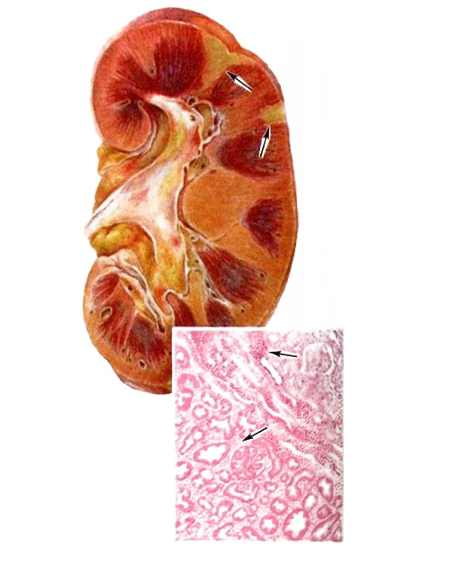 на рисунке: белые инфаркты почек; на макропрепарате внизу - участок белого инфаркт, вверху - геморрагический пояс по периферии на рисунке: белые инфаркты почек; на макропрепарате внизу - участок белого инфаркт, вверху - геморрагический пояс по периферии