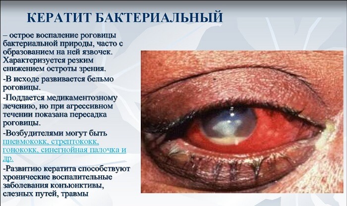 Бактериальный кератит человека