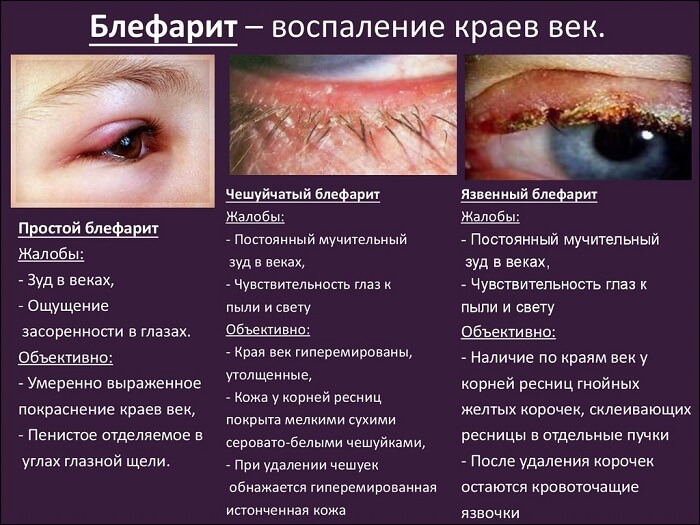 Блефарит глаз человека