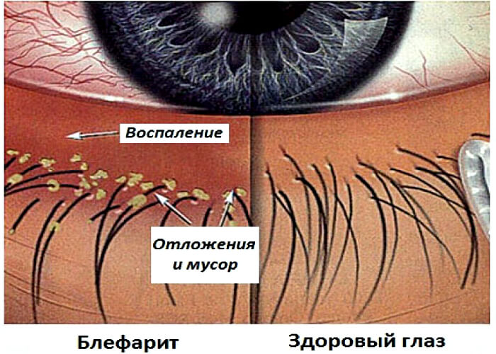 Блефарит глазного яблока