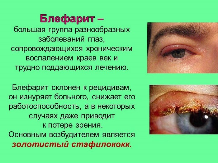 Блефарит на глазу