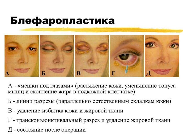 Блефоропластика для человека