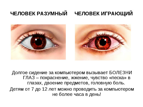 Болезнь глаз от компьютера