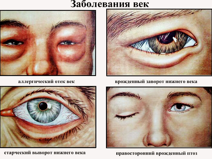 Болезни верхнего века