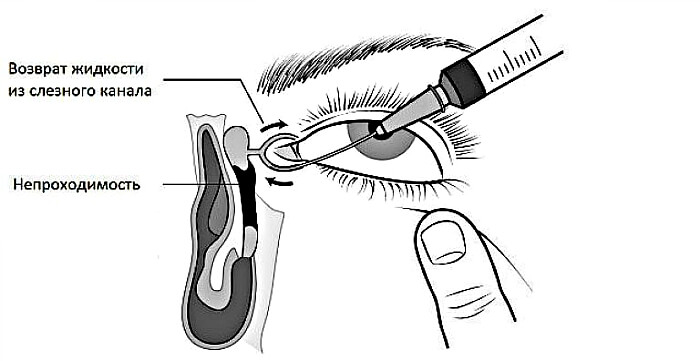 Бужирование слезного канала