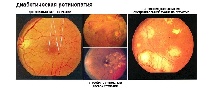 Диабетическая ретинопатиия