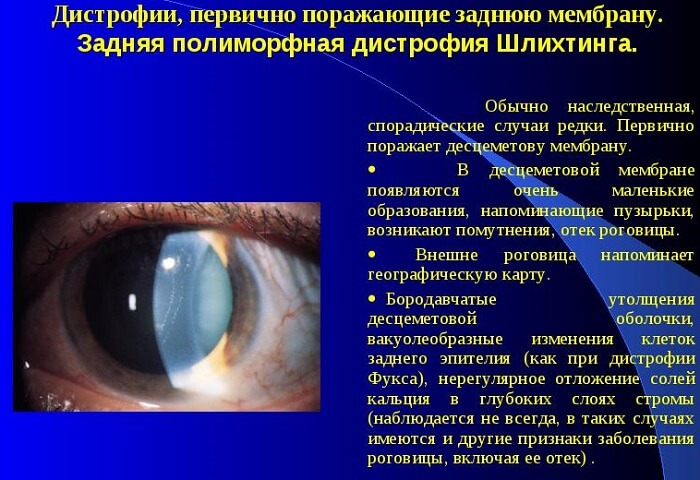 Дистрофия роговицы глаза