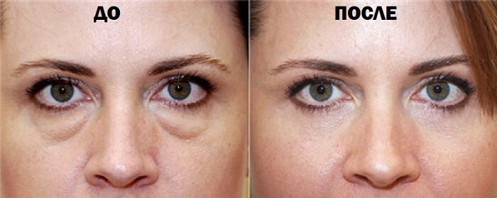 До и после использования