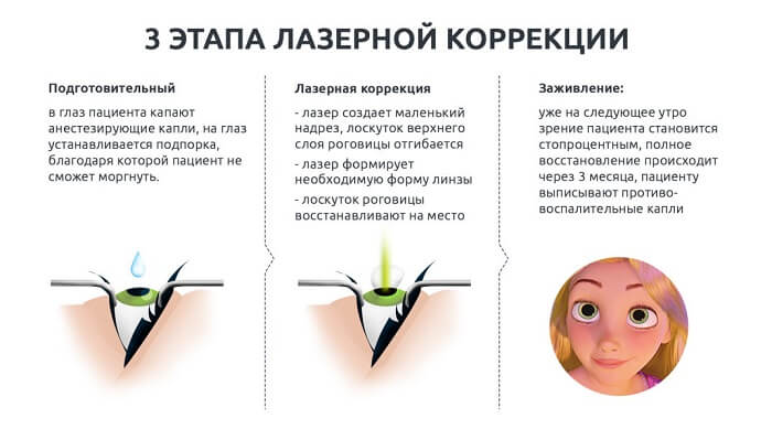 Этапы лазерной коррекции