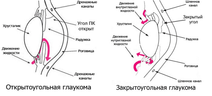 Формы глаукомы