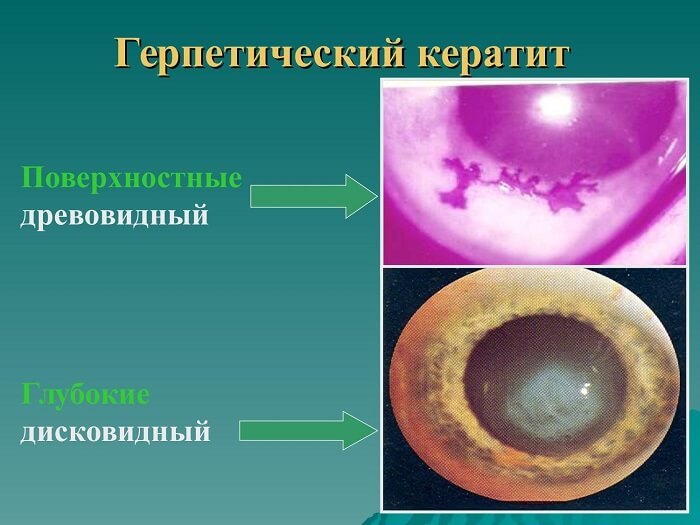 Герпетический кератит