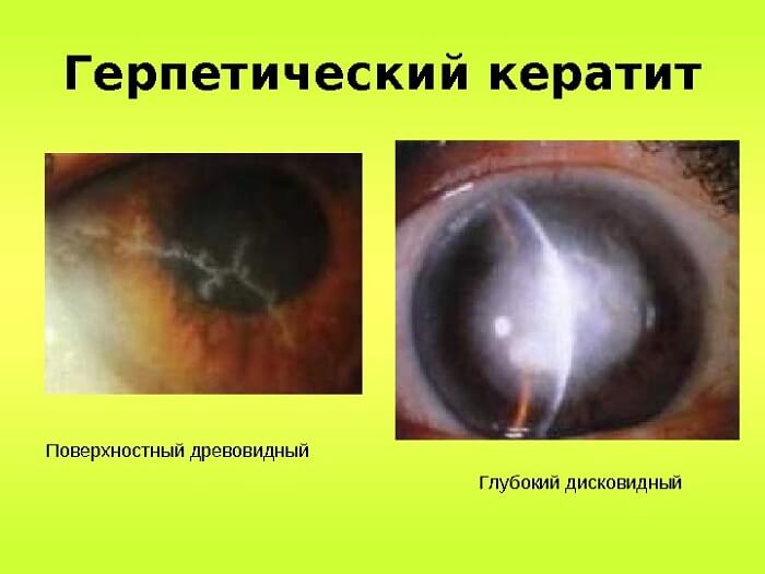 Герпетический кератит