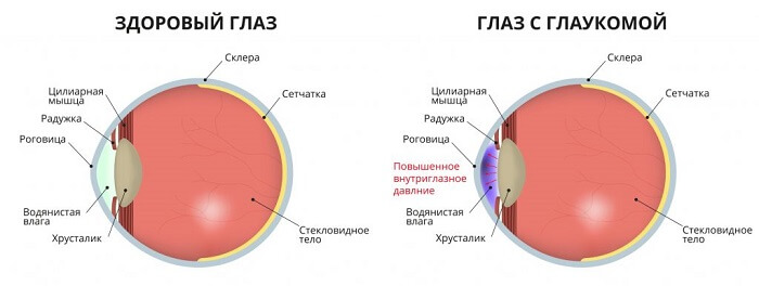 Глаз с глаукомой