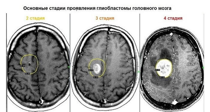 Глиобластома головного мозга