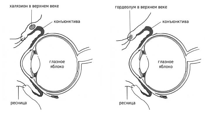 Халязион в глазу у человека