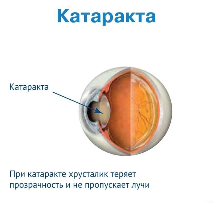 Характеристика катаракты