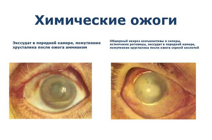 Химические ожоги глаз