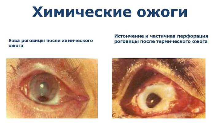 Химические ожоги роговицы