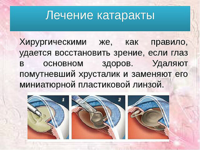 Хирургическое лечение катаракты