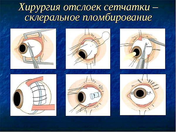 Хирургия отслойки сетчатки