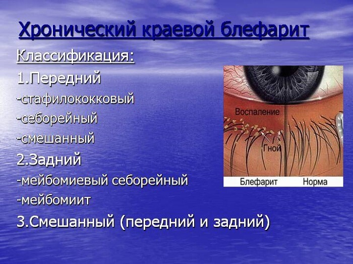Хронический блефарит