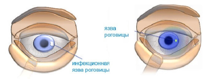 Инфекции роговицы глаза