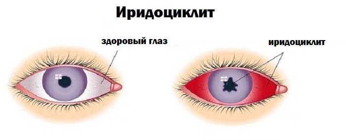 Иридоциклит глаза человека