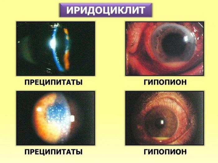 Иридоциклит глаза человека