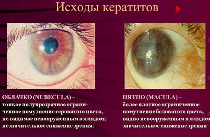 Исходы кератитов