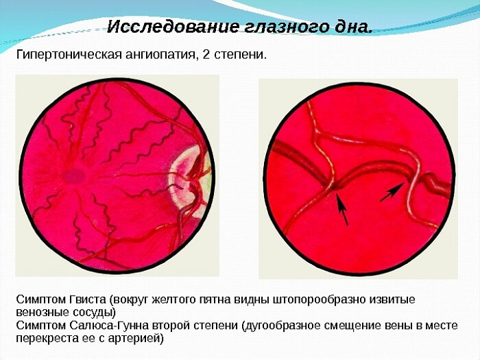 Исследование глазного дна