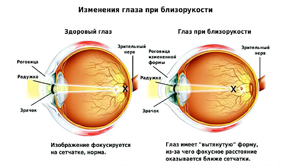 Изменение глаза при близорукости
