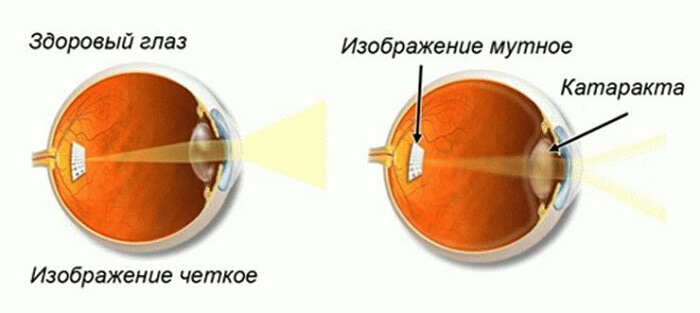 Катаракта глаза