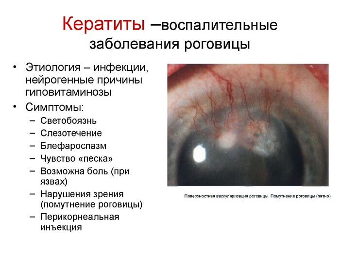 Кератит - воспаление роговиц