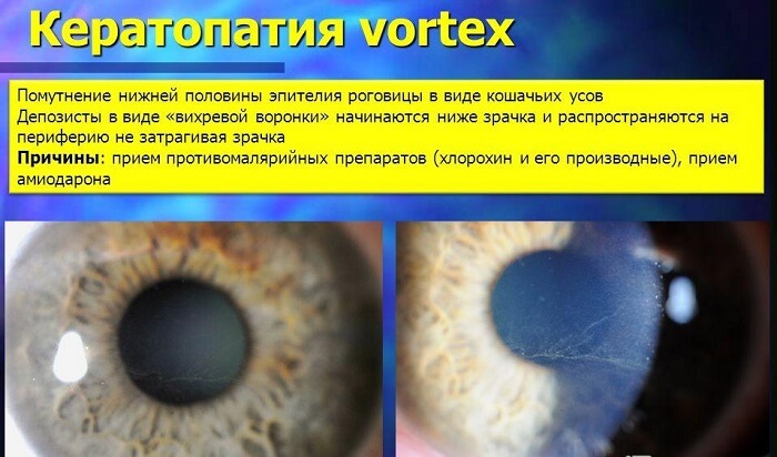 Кератопатия глаза человека
