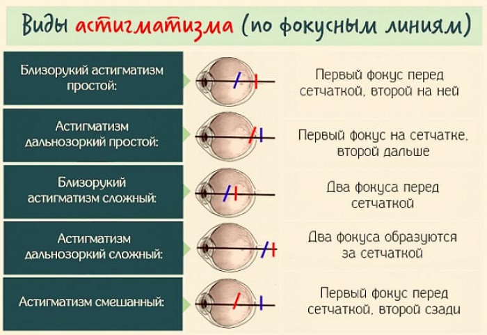 Виды астигматизма Классификация астигматизма