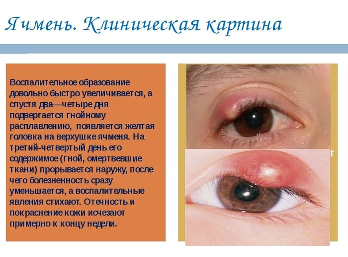 Клиническая картина ячменя