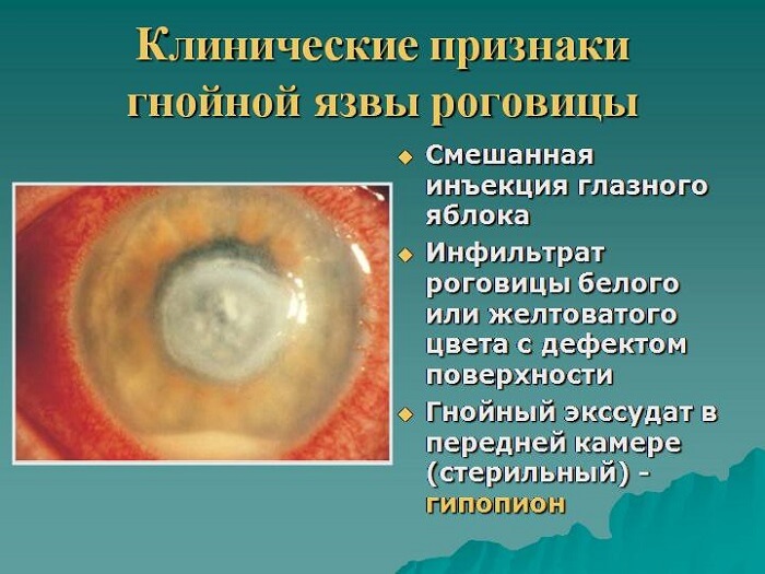 Клинические признаки язвы