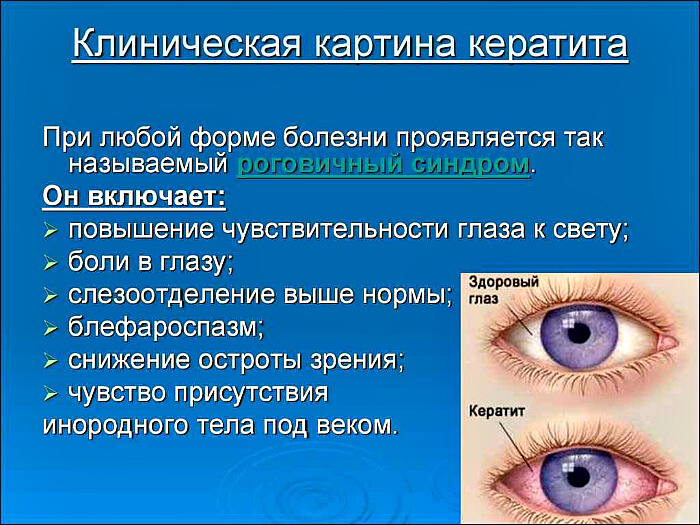 Клиника кератита