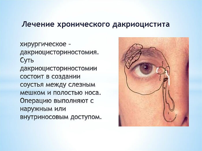 Лечение хронического дакриоцистита
