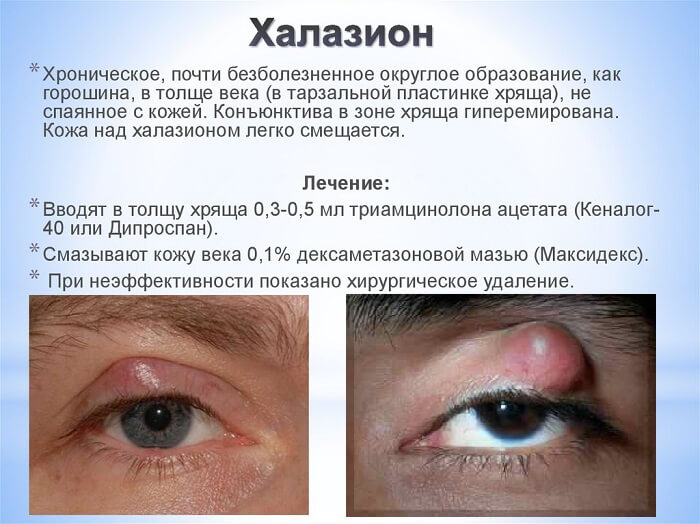 Лечение хронического халазиона