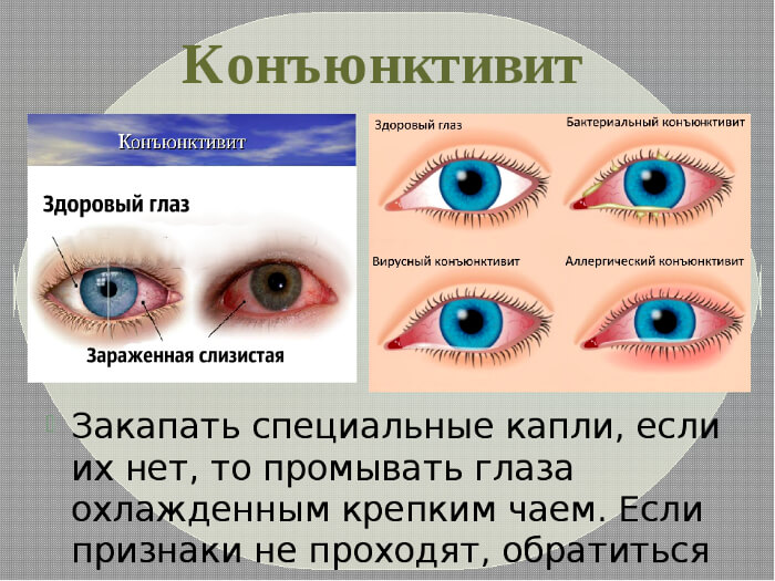 Лечение конъюктивита
