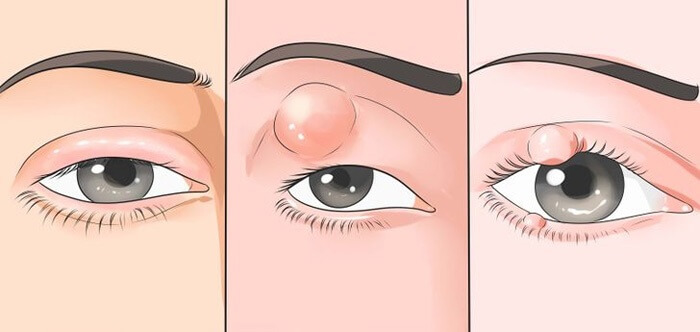 Локализация ячменя на глазу