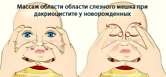 Массаж слезного мешка