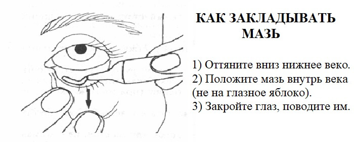 Методика закладывания мази