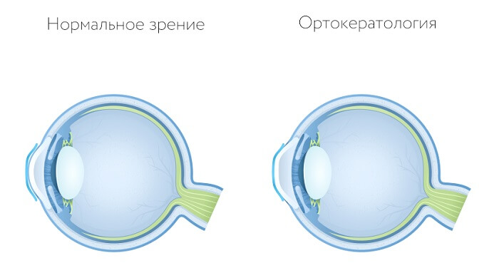 Ортокератология у человека