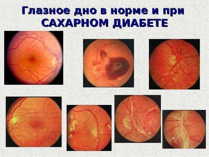 Норма и диабет по изучению глазного дна